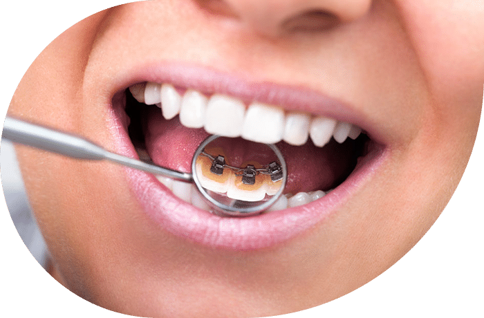 ارتودنسی لینگوال