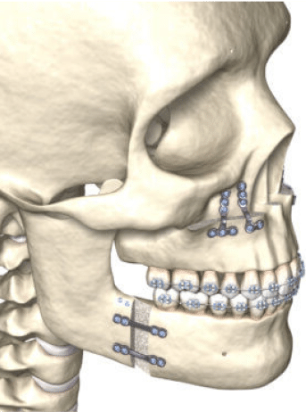 ارتودنسی جراحی یا Orthognathic