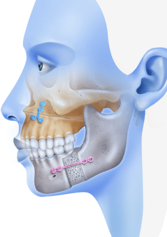 ارتودنسی جراحی یا Orthognathic